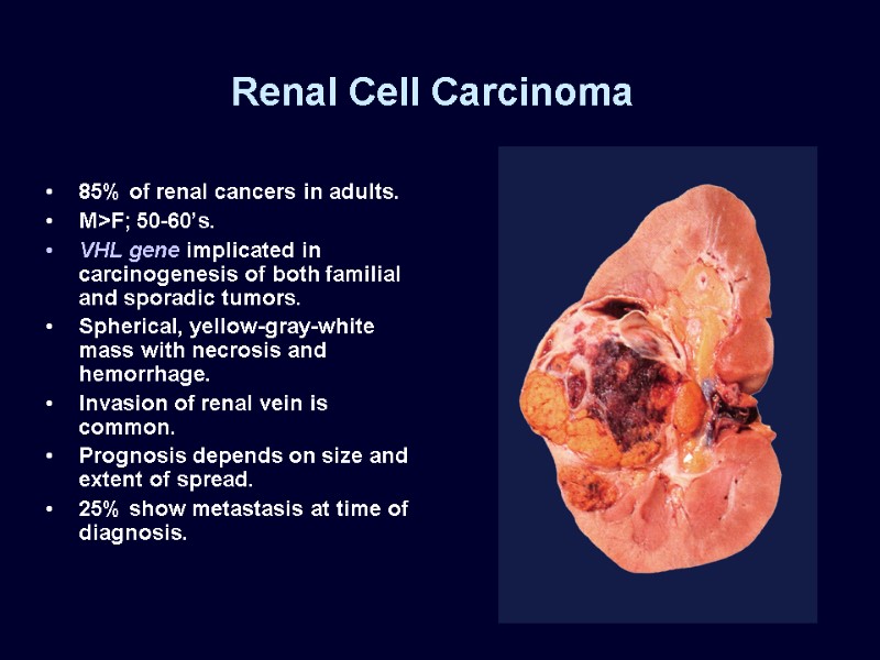 Renal Cell Carcinoma 85% of renal cancers in adults. M>F; 50-60’s. VHL gene implicated